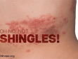 1 in Every 3 People in The US Will Develop Shingles During Their Lifetime